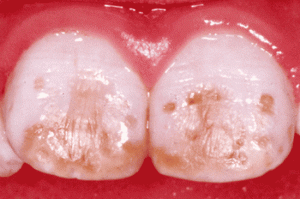 fluorosis16